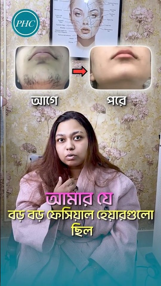 Before-and-after close-up of a patient's jawline showing facial hair reduction, with the patient seated in a robe speaking directly to camera.