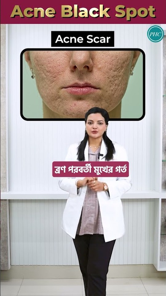 Close-up of acne scarring and open pores on a patient's lower face under an 'Acne Black Spot' banner, with Dr. Tasmin Tahnin Siha in a white coat presenting the comparison.
